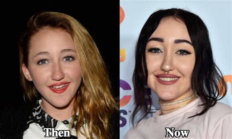 noah cyrus nose job|Noah Cyruss plastic surgery